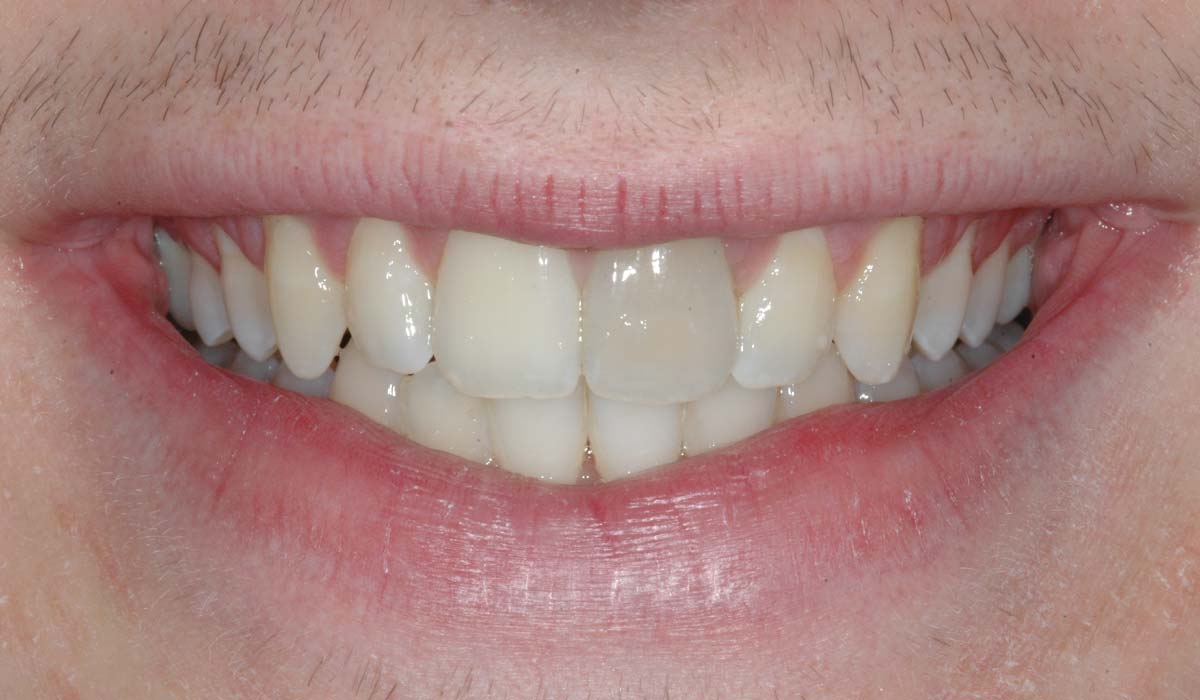 Single Whitening 3