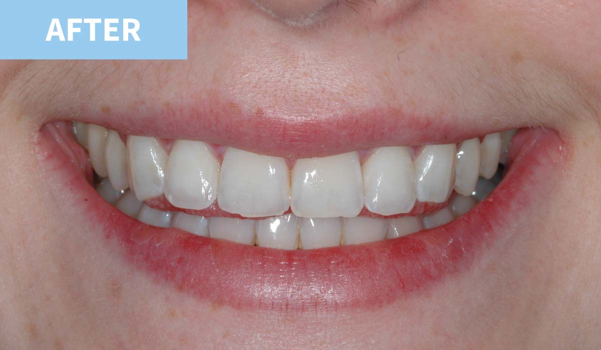 Teeth Whitening 10