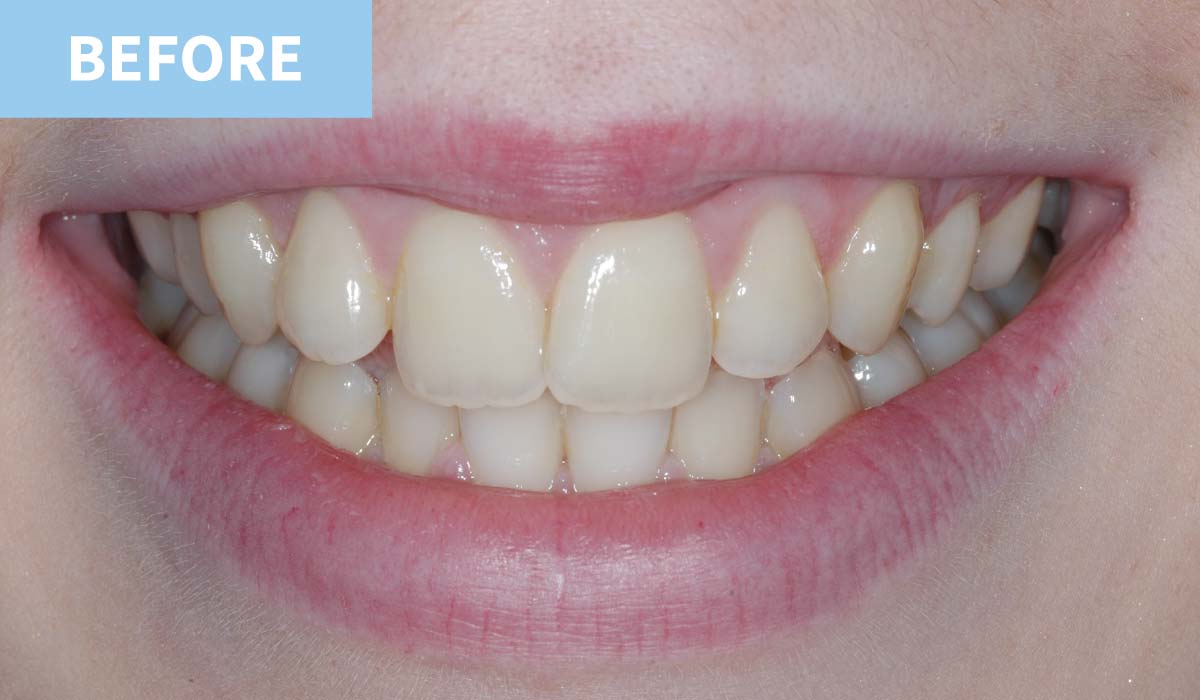 Teeth Whitening 11