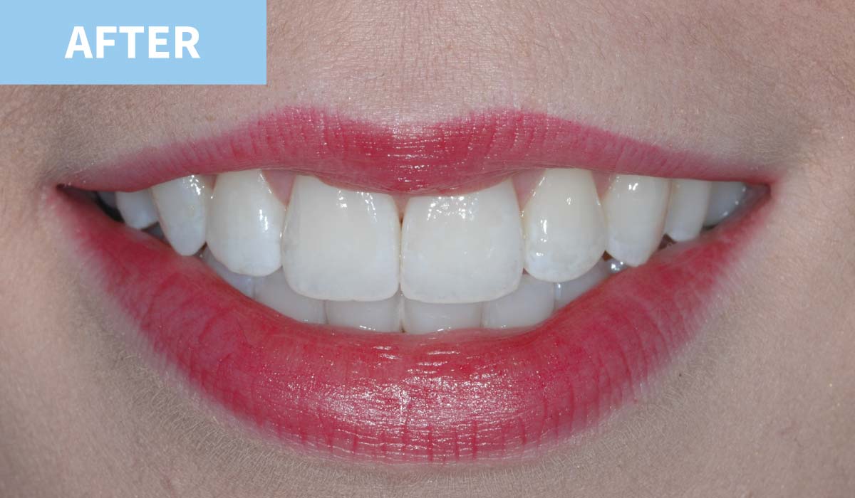 Teeth Whitening 12