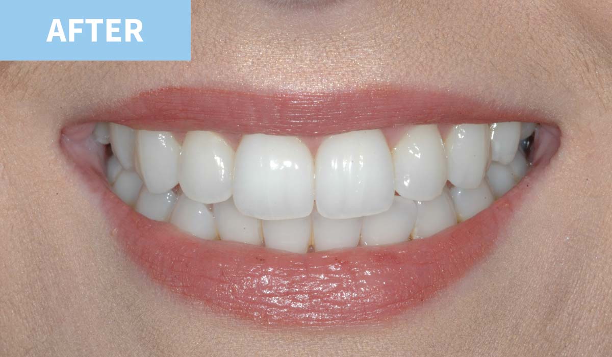 Teeth Whitening 2