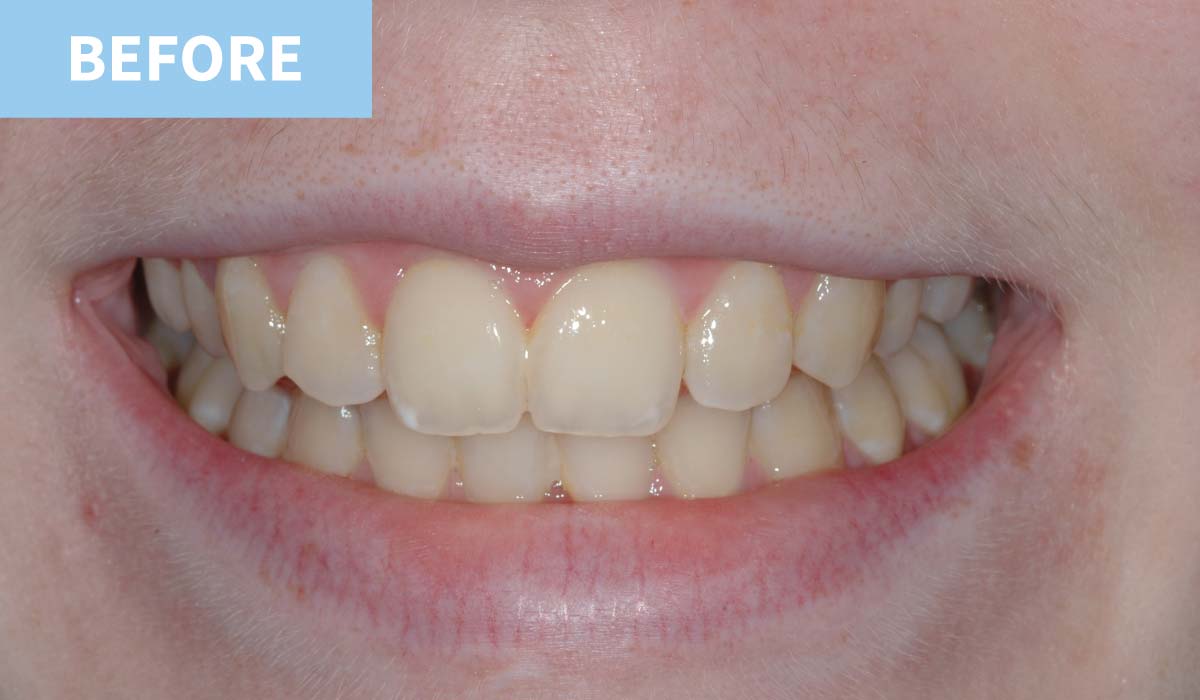Teeth Whitening 5