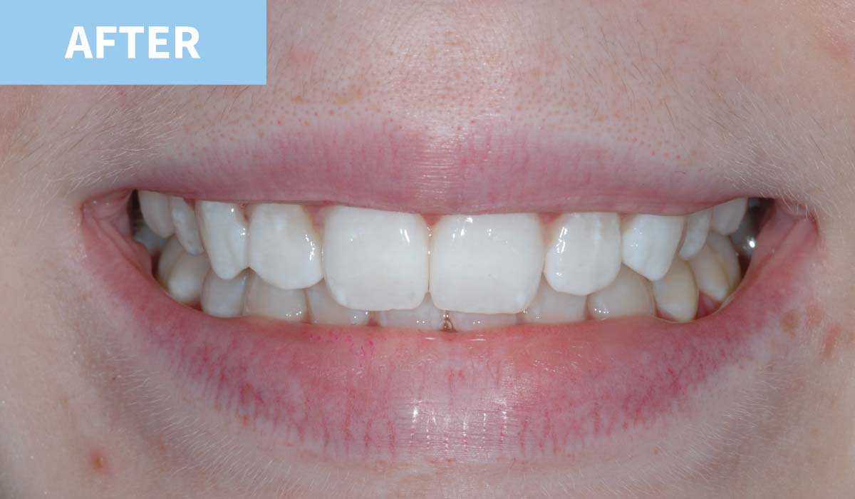 Teeth Whitening 6