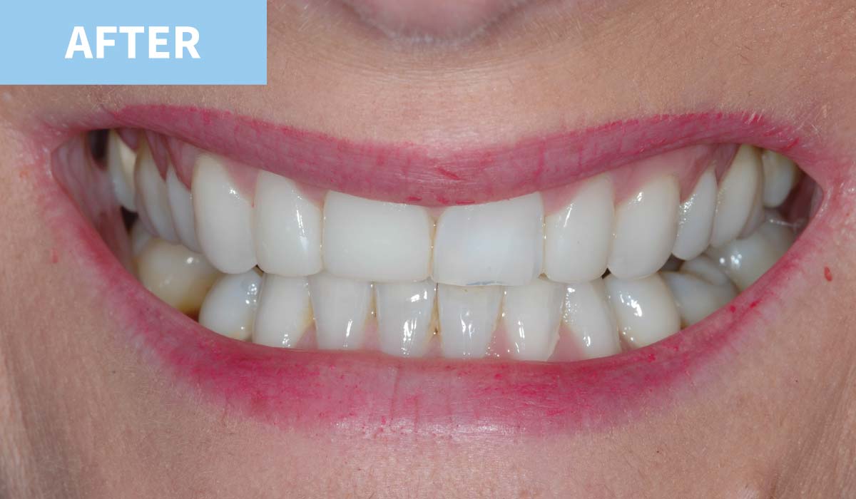 Teeth Whitening 8