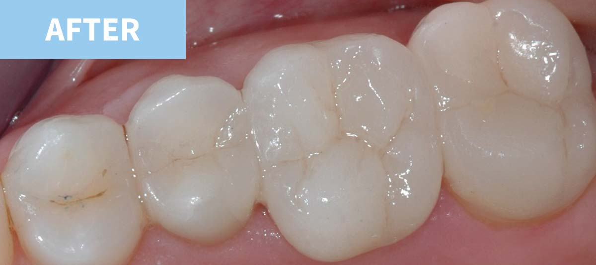 White Fillings 2