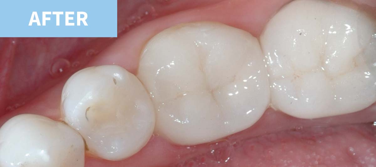 White Fillings 4