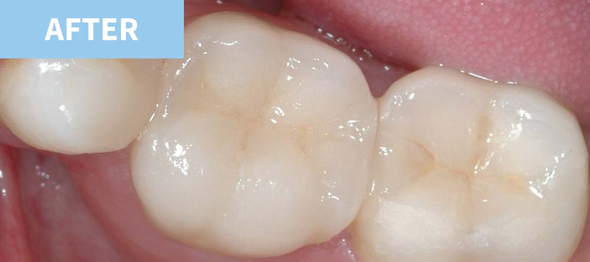 White Fillings 6