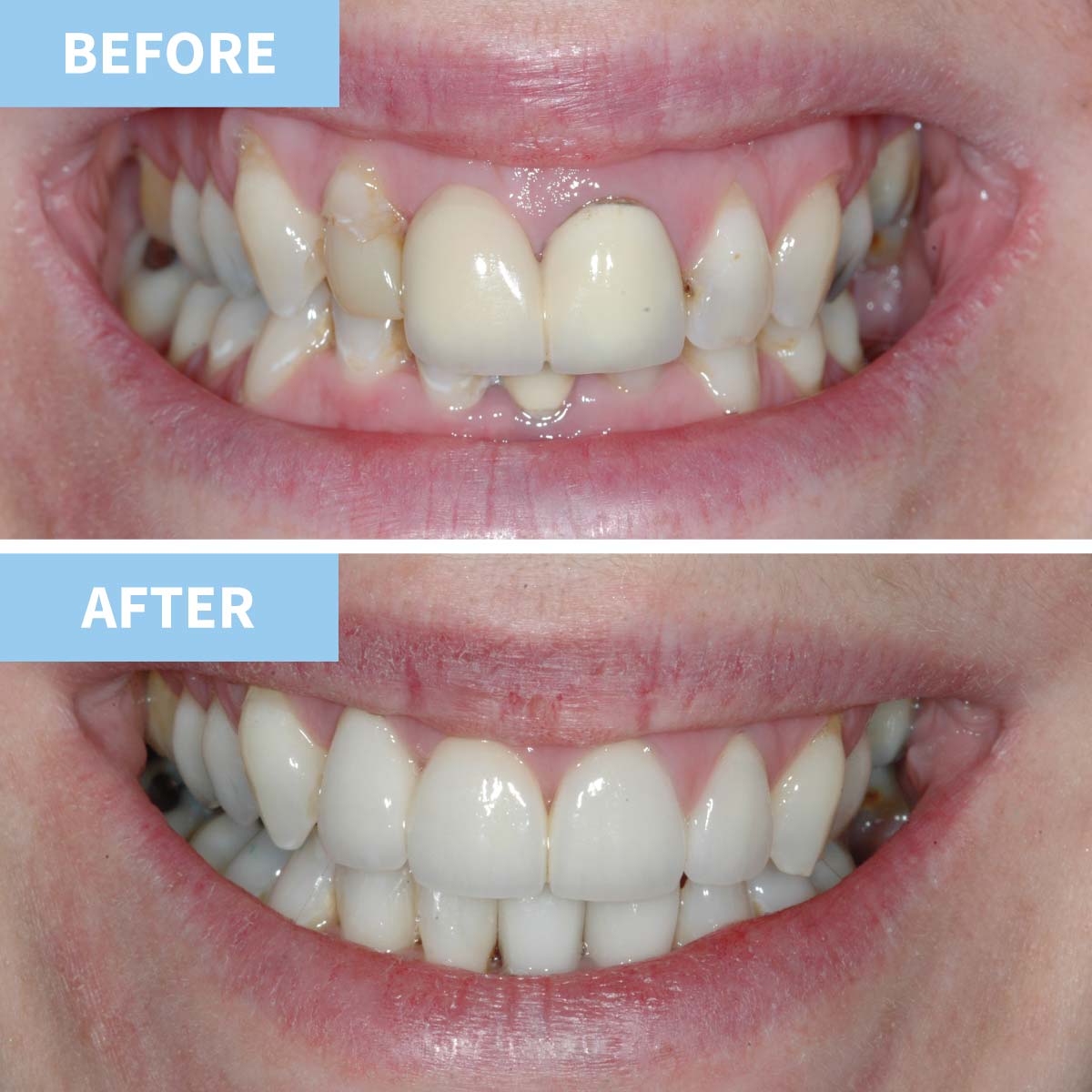 Smile Makeover |Award Winning Murray Dentists Omagh