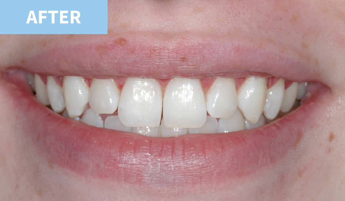 Teeth Whitening |Award Winning Murray Dentists Omagh